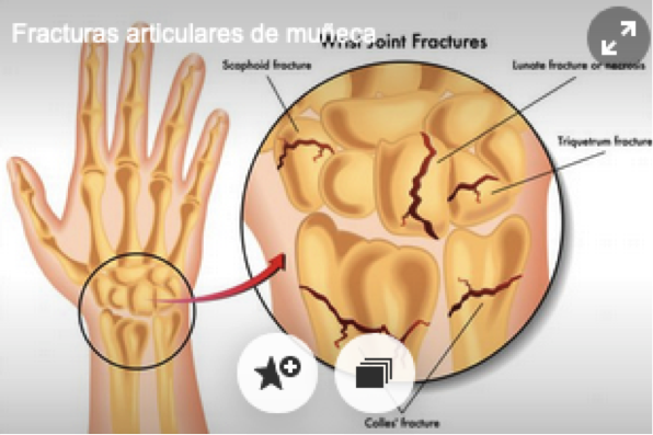 FRACTURAS DE MUÑECA Dr Ángel Torres