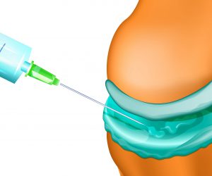 vector illustration of an injectable treatment of joints